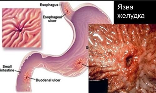 Симптомы и лечение язвы желудка в период обострения Симптомы и лечение язвы желудка в период обострения