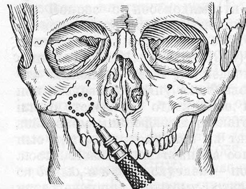 Симптомы и лечение одонтогенного гайморита Симптомы и лечение одонтогенного гайморита