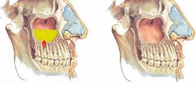 Симптомы и лечение одонтогенного гайморита Симптомы и лечение одонтогенного гайморита