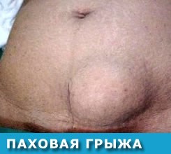 Болит низ живота справа: причины и возможные заболевания Болит низ живота справа: причины и возможные заболевания