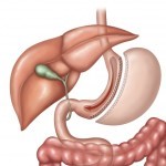 Особенности операции по удалению желудка Особенности операции по удалению желудка