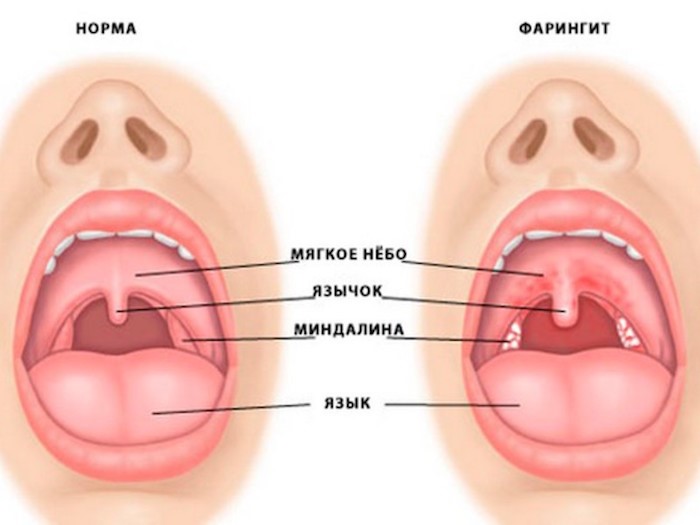 Что делать, если опухла гланда и стало больно глотать? Что делать, если опухла гланда и стало больно глотать?