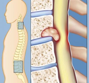 Опухоль позвоночника Опухоль позвоночника