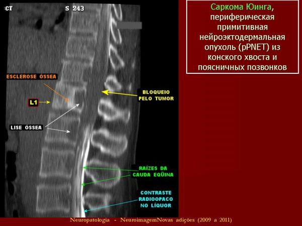 Опухоль позвоночника Опухоль позвоночника