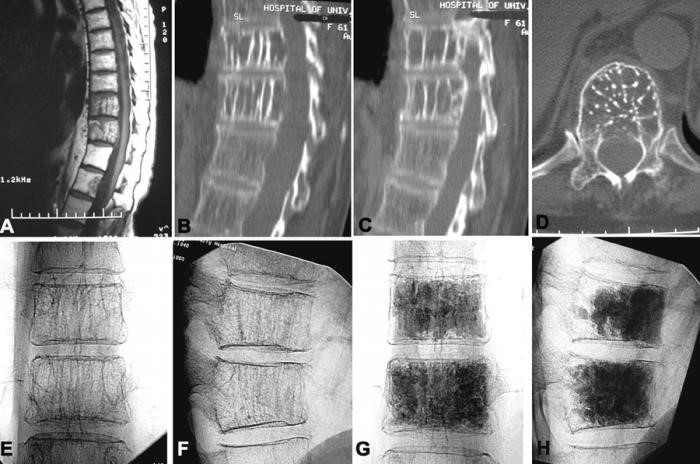 Опухоль позвоночника Опухоль позвоночника