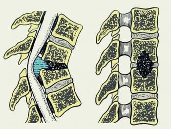 Опухоль позвоночника Опухоль позвоночника