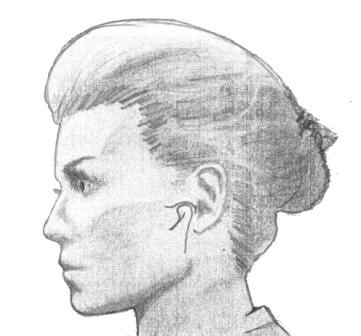 Остеоартроз височно-нижнечелюстного сустава: лечение ВНЧС Остеоартроз височно-нижнечелюстного сустава: лечение ВНЧС