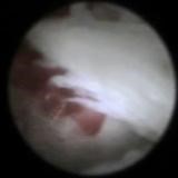 Остеоартроз височно-нижнечелюстного сустава: лечение ВНЧС Остеоартроз височно-нижнечелюстного сустава: лечение ВНЧС