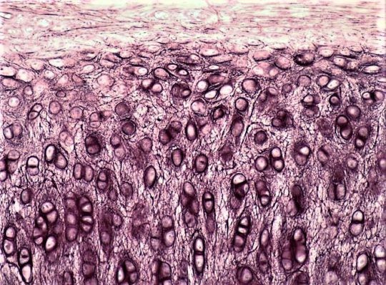 Остеопороз коленного сустава: симптомы и лечение колена Остеопороз коленного сустава: симптомы и лечение колена