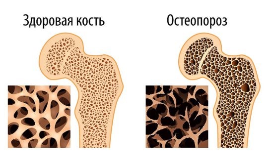 Остеопороз коленного сустава: симптомы и лечение колена Остеопороз коленного сустава: симптомы и лечение колена