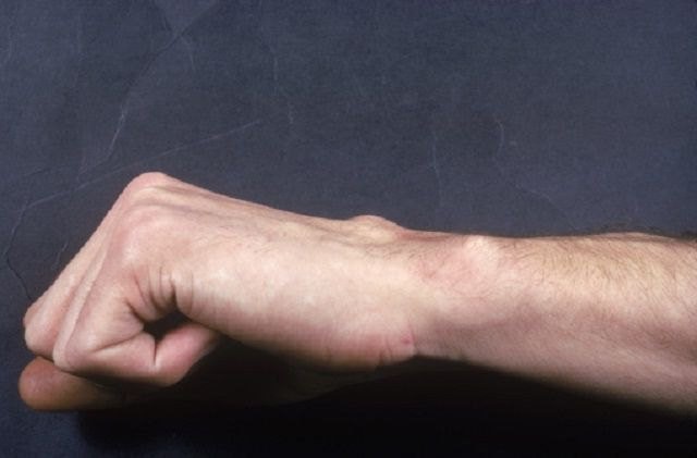 Что такое субхондральный остеосклероз: описание (определение, симптомы), причины, лечение Что такое субхондральный остеосклероз: описание (определение, симптомы), причины, лечение