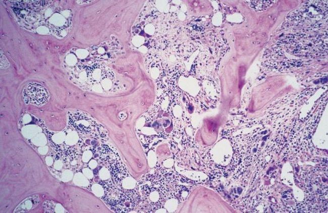 Что такое субхондральный остеосклероз: описание (определение, симптомы), причины, лечение Что такое субхондральный остеосклероз: описание (определение, симптомы), причины, лечение