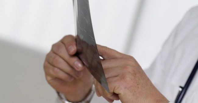 Что такое субхондральный остеосклероз: описание (определение, симптомы), причины, лечение Что такое субхондральный остеосклероз: описание (определение, симптомы), причины, лечение