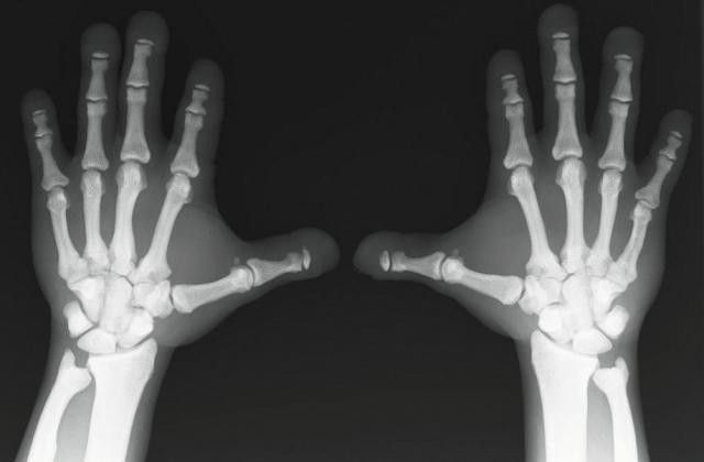 Что такое субхондральный остеосклероз: описание (определение, симптомы), причины, лечение Что такое субхондральный остеосклероз: описание (определение, симптомы), причины, лечение