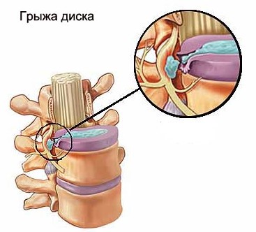Симптомы, диагностика и эффективное лечение остеохондроза грудной клетки Симптомы, диагностика и эффективное лечение остеохондроза грудной клетки