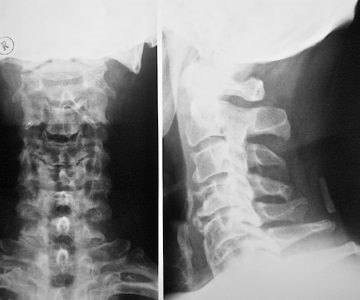 Симптомы, диагностика и эффективное лечение остеохондроза грудной клетки Симптомы, диагностика и эффективное лечение остеохондроза грудной клетки