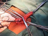 Факторы вызывающие гнойный аппендицит и методы его лечения Факторы вызывающие гнойный аппендицит и методы его лечения