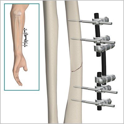 Причины, признаки и лечение перелома костей предплечья Причины, признаки и лечение перелома костей предплечья