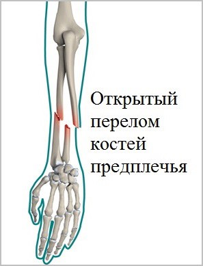 Причины, признаки и лечение перелома костей предплечья Причины, признаки и лечение перелома костей предплечья