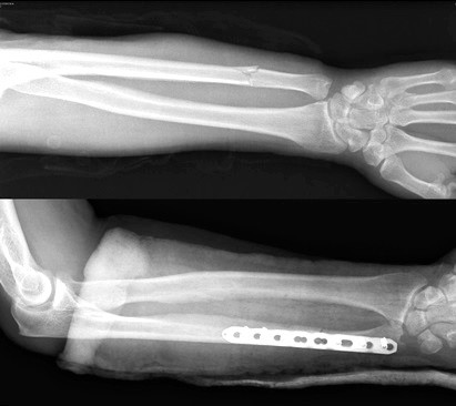 Причины, признаки и лечение перелома костей предплечья Причины, признаки и лечение перелома костей предплечья