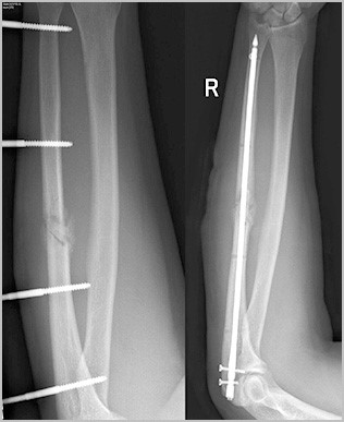 Причины, признаки и лечение перелома костей предплечья Причины, признаки и лечение перелома костей предплечья