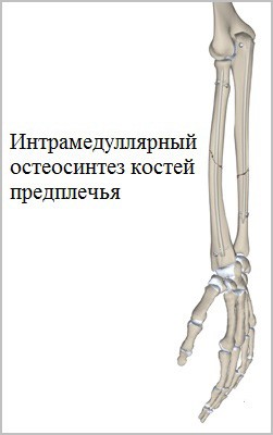 Причины, признаки и лечение перелома костей предплечья Причины, признаки и лечение перелома костей предплечья