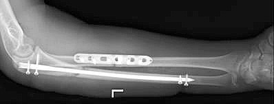 Причины, признаки и лечение перелома костей предплечья Причины, признаки и лечение перелома костей предплечья