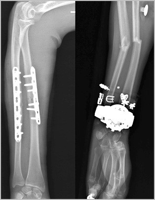 Причины, признаки и лечение перелома костей предплечья Причины, признаки и лечение перелома костей предплечья
