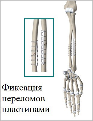 Причины, признаки и лечение перелома костей предплечья Причины, признаки и лечение перелома костей предплечья