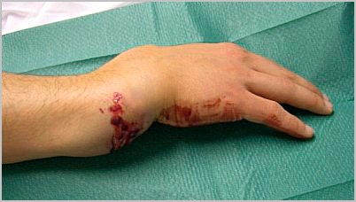 Причины, признаки и лечение перелома костей предплечья Причины, признаки и лечение перелома костей предплечья