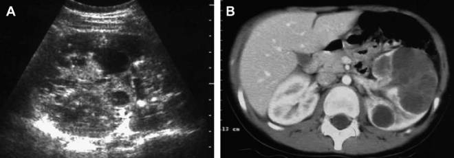 Особенности паренхиматозной кисты почки Особенности паренхиматозной кисты почки
