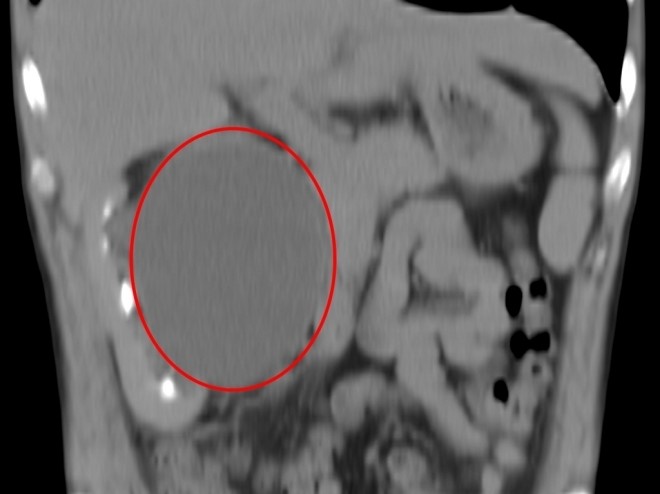 Особенности паренхиматозной кисты почки Особенности паренхиматозной кисты почки