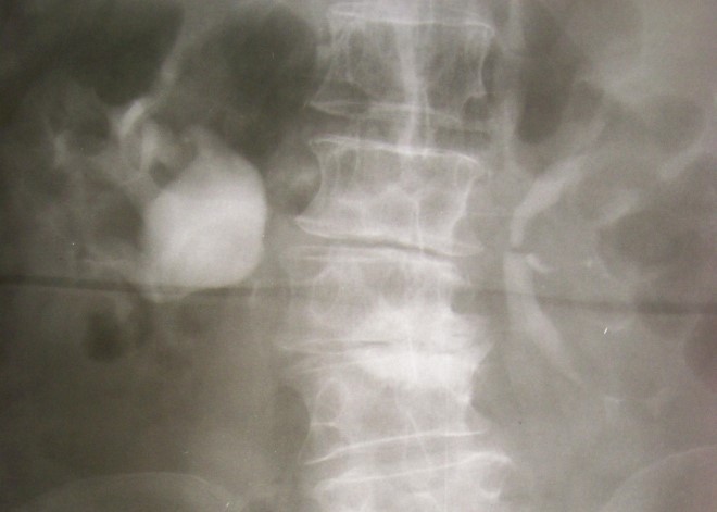 Особенности паренхиматозной кисты почки Особенности паренхиматозной кисты почки