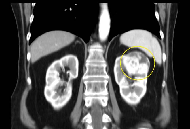 Особенности паренхиматозной кисты почки Особенности паренхиматозной кисты почки