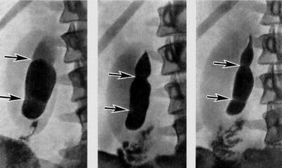О чем говорит наличие диффузных изменений в поджелудочной железе О чем говорит наличие диффузных изменений в поджелудочной железе
