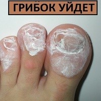 Признаки и лечение перелома большого пальца ноги Признаки и лечение перелома большого пальца ноги