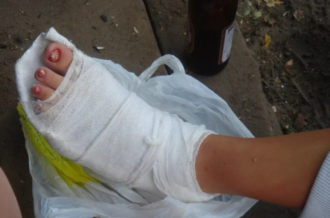 Признаки и лечение перелома большого пальца ноги Признаки и лечение перелома большого пальца ноги