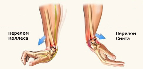 Виды и методы лечения переломов лучевой кости Виды и методы лечения переломов лучевой кости