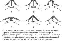 Перелом носа: признаки, лечение травмы, со смещением и без Перелом носа: признаки, лечение травмы, со смещением и без