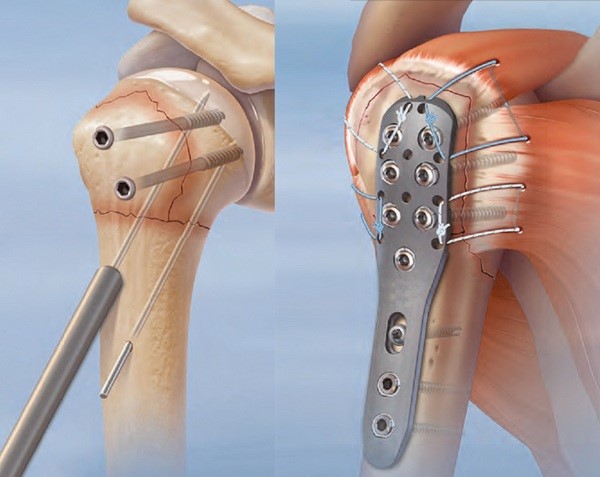 Строение и травмы плечевой кости Строение и травмы плечевой кости