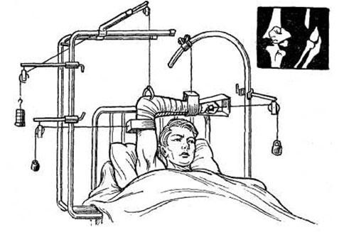 Строение и травмы плечевой кости Строение и травмы плечевой кости