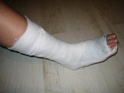 Причины и лечение перелома таранной кости Причины и лечение перелома таранной кости