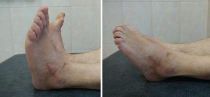 Причины и лечение перелома таранной кости Причины и лечение перелома таранной кости