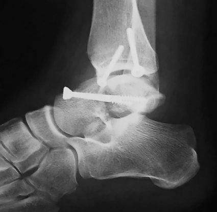 Причины и лечение перелома таранной кости Причины и лечение перелома таранной кости