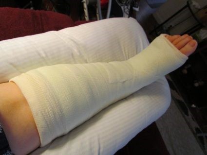 Причины и лечение перелома таранной кости Причины и лечение перелома таранной кости