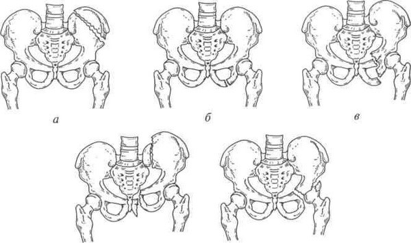 Симптомы и лечение перелома лонной кости таза Симптомы и лечение перелома лонной кости таза