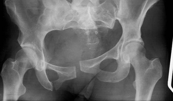 Симптомы и лечение перелома лонной кости таза Симптомы и лечение перелома лонной кости таза