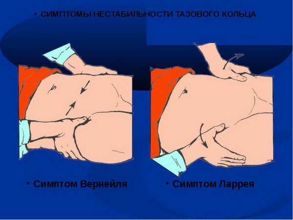 Симптомы и лечение перелома лонной кости таза Симптомы и лечение перелома лонной кости таза