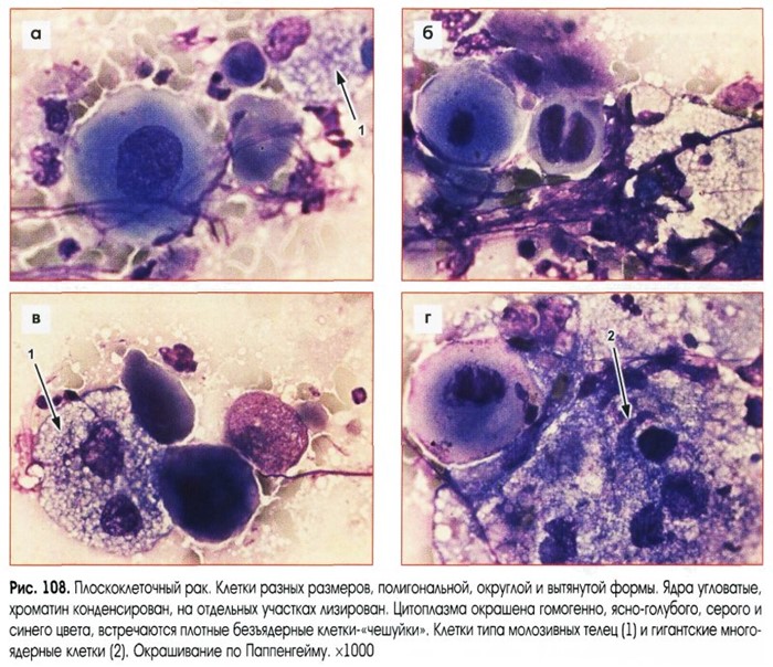Лечение и симптомы рака легких 4 стадии Лечение и симптомы рака легких 4 стадии