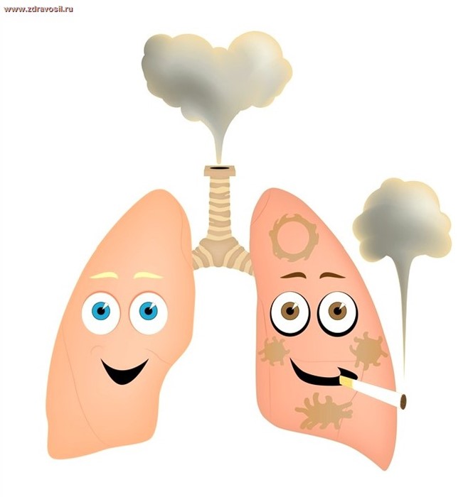 Лечение и симптомы рака легких 4 стадии Лечение и симптомы рака легких 4 стадии